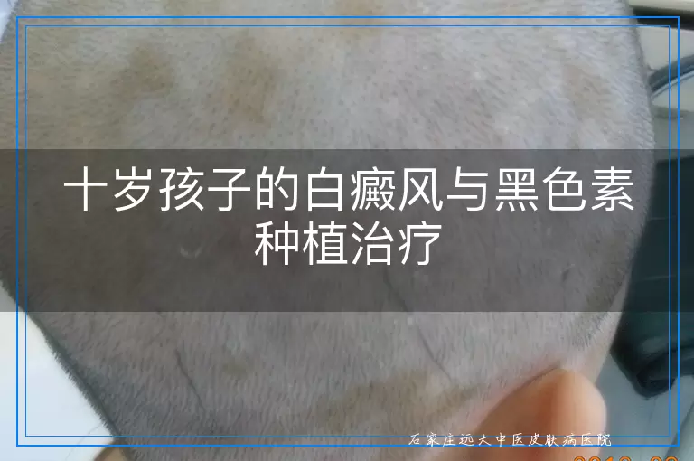 十岁孩子的白癜风与黑色素种植治疗
