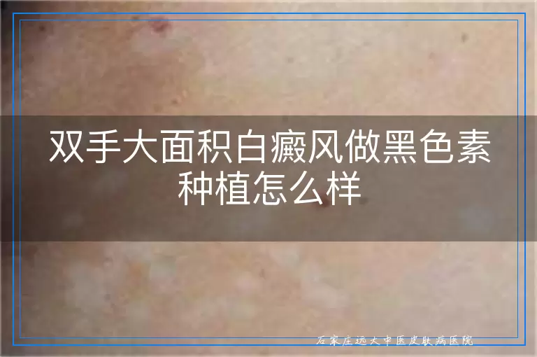 双手大面积白癜风做黑色素种植怎么样