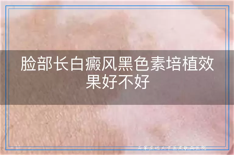 脸部长白癜风黑色素培植效果好不好