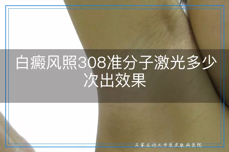 白癜风照308准分子激光多少次出效果