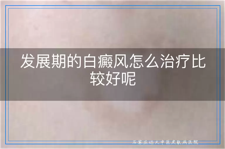 发展期的白癜风怎么治疗比较好呢