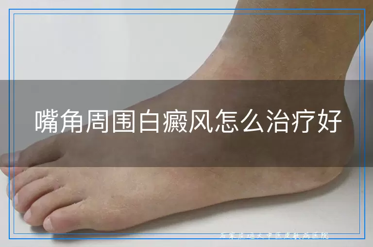 嘴角周围白癜风怎么治疗好