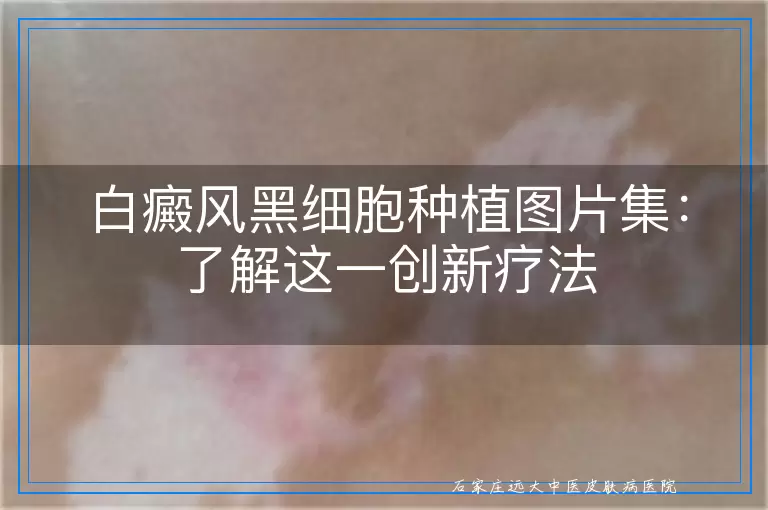 白癜风黑细胞种植图片集：了解这一创新疗法