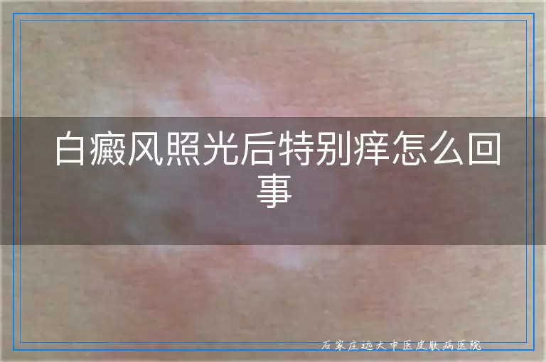 白癜风照光后特别痒怎么回事