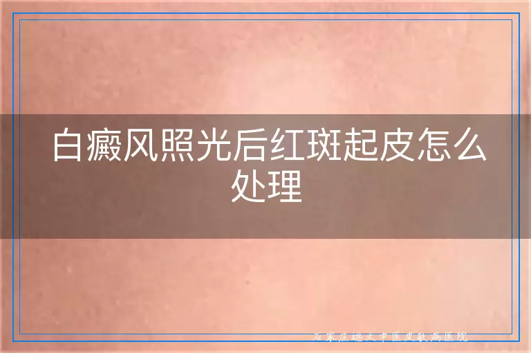 白癜风照光后红斑起皮怎么处理