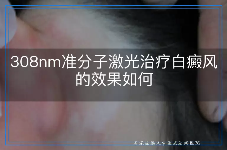308nm准分子激光治疗白癜风的效果如何
