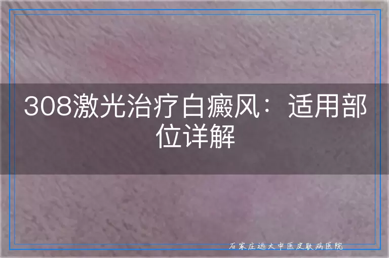 308激光治疗白癜风：适用部位详解