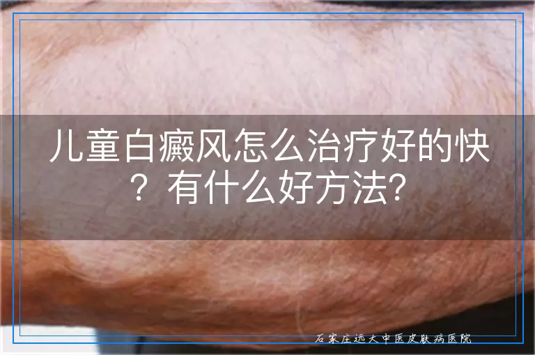 儿童白癜风怎么治疗好的快？有什么好方法？