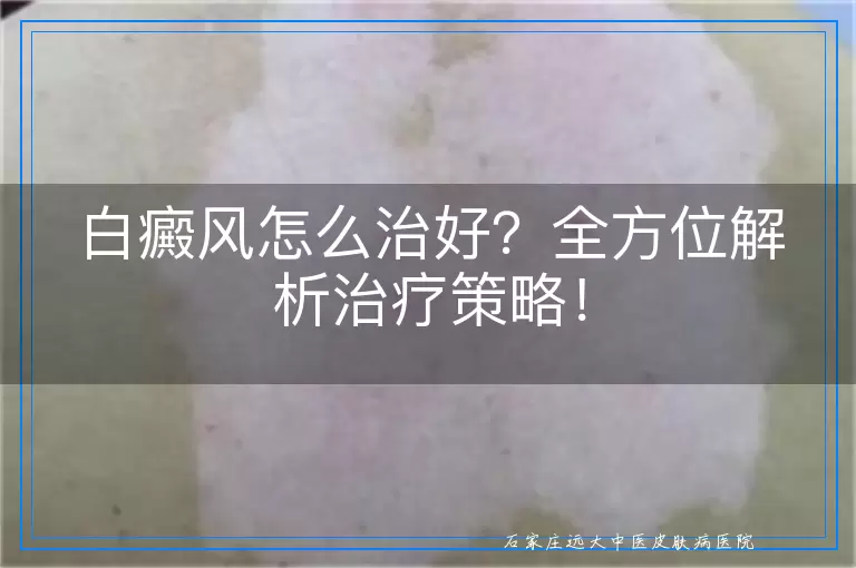 白癜风怎么治好？全方位解析治疗策略！