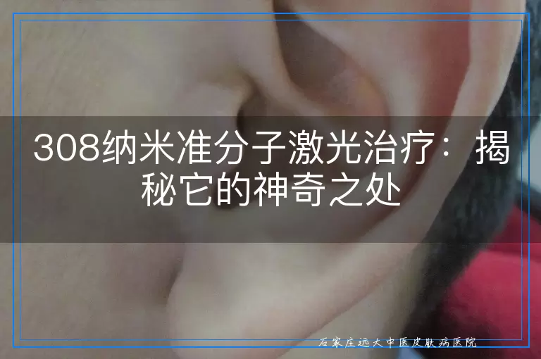 308纳米准分子激光治疗：揭秘它的神奇之处