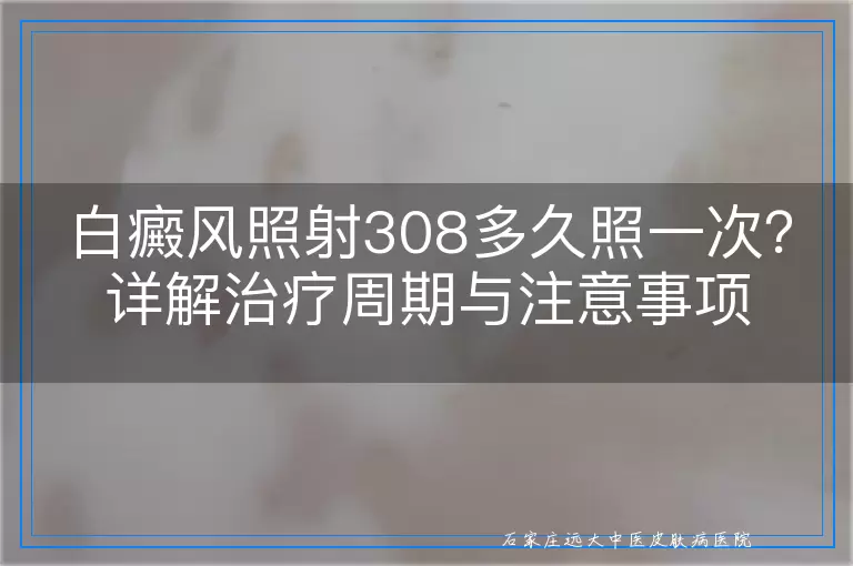 白癜风照射308多久照一次？详解治疗周期与注意事项