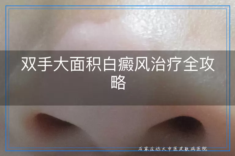 双手大面积白癜风治疗全攻略