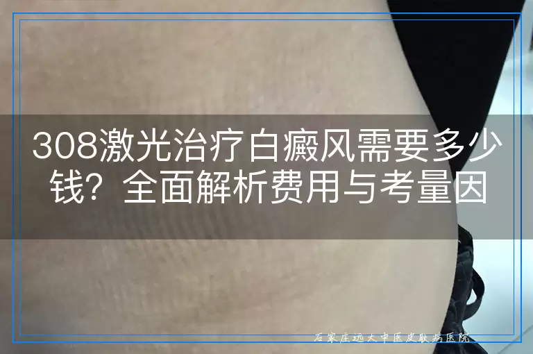 308激光治疗白癜风需要多少钱？全面解析费用与考量因素