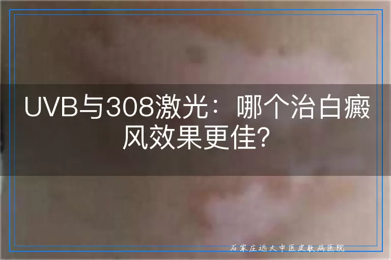 UVB与308激光：哪个治白癜风效果更佳？