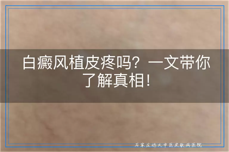 白癜风植皮疼吗？一文带你了解真相！