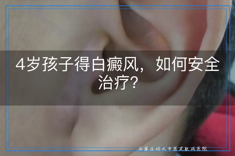 4岁孩子得白癜风，如何安全治疗？