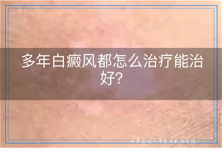 多年白癜风都怎么治疗能治好？
