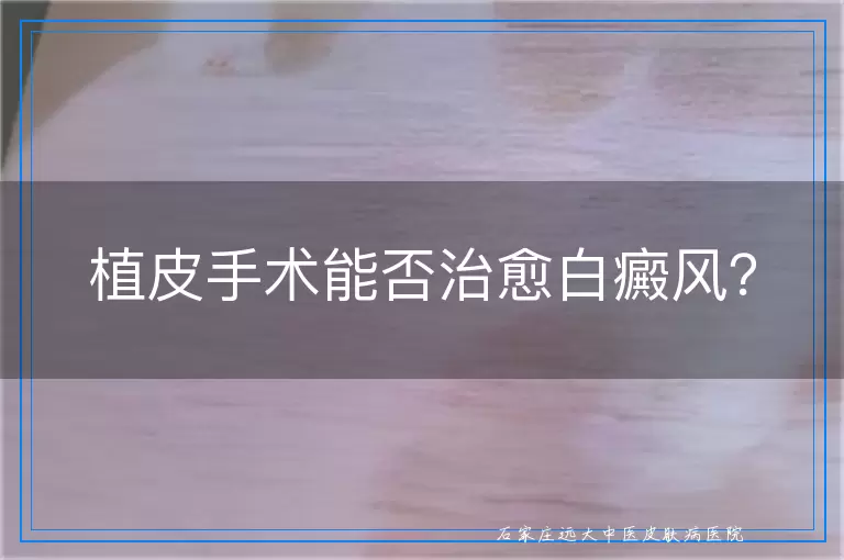 植皮手术能否治愈白癜风？