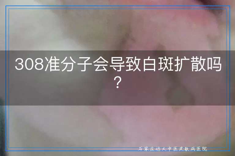 308准分子会导致白斑扩散吗？