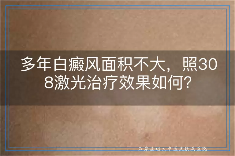 多年白癜风面积不大，照308激光治疗效果如何？