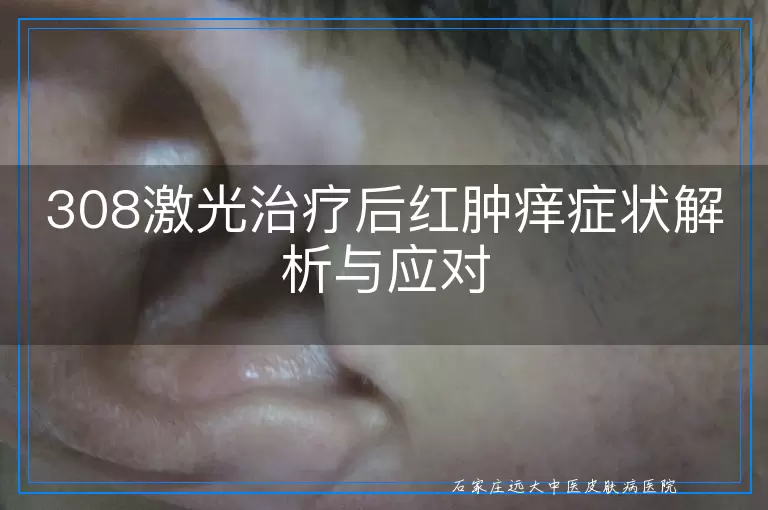 308激光治疗后红肿痒症状解析与应对
