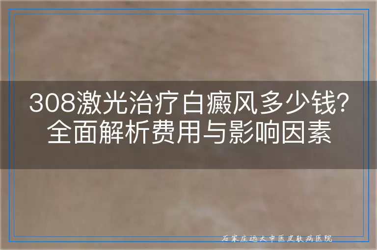 308激光治疗白癜风多少钱？全面解析费用与影响因素