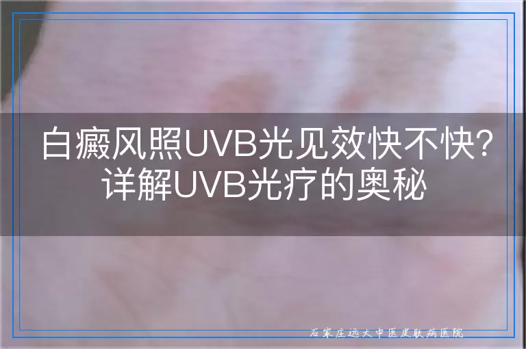 白癜风照UVB光见效快不快？详解UVB光疗的奥秘