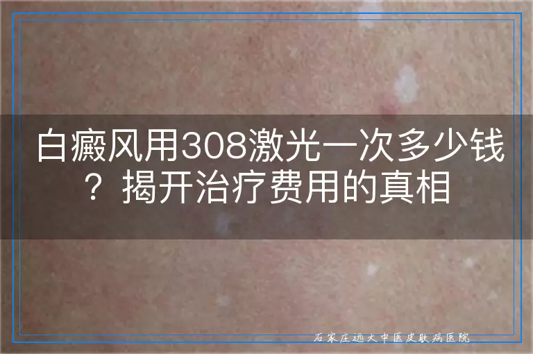 白癜风用308激光一次多少钱？揭开治疗费用的真相