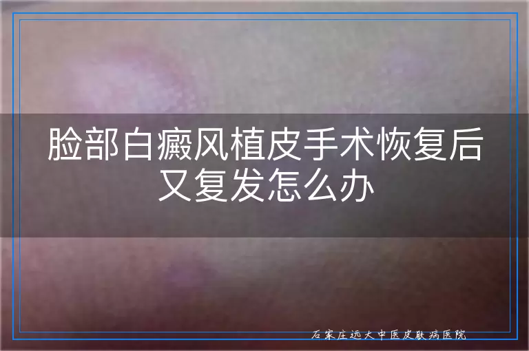 脸部白癜风植皮手术恢复后又复发怎么办