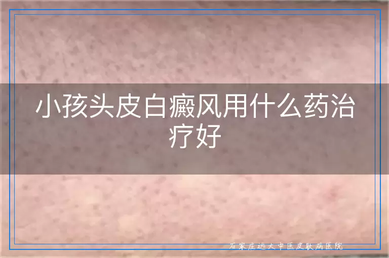小孩头皮白癜风用什么药治疗好