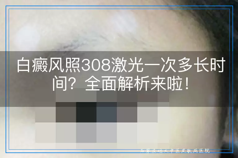 白癜风照308激光一次多长时间？全面解析来啦！