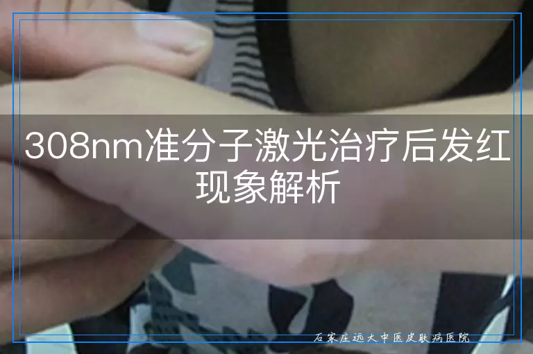 308nm准分子激光治疗后发红现象解析