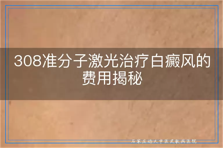 308准分子激光治疗白癜风的费用揭秘
