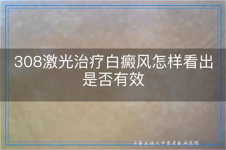 308激光治疗白癜风怎样看出是否有效