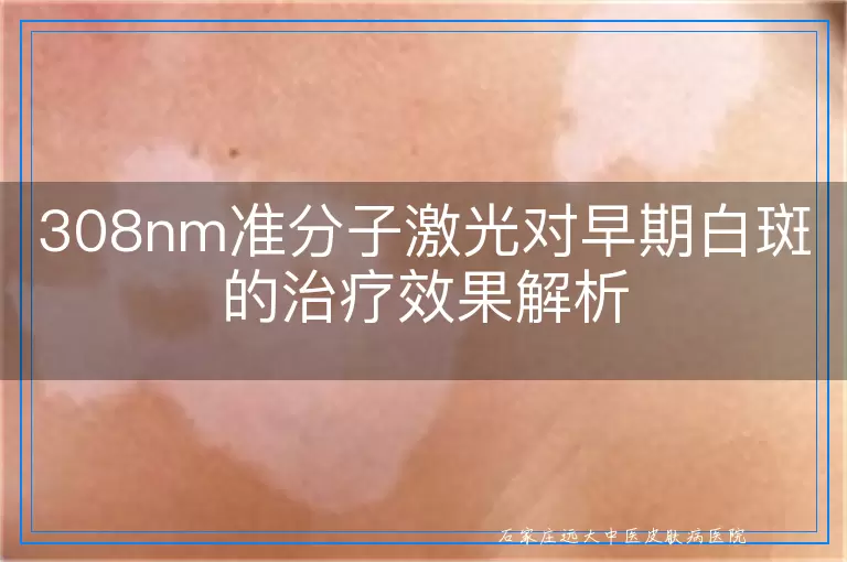 308nm准分子激光对早期白斑的治疗效果解析