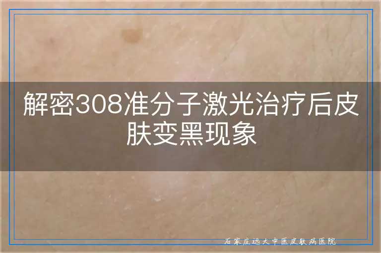 解密308准分子激光治疗后皮肤变黑现象
