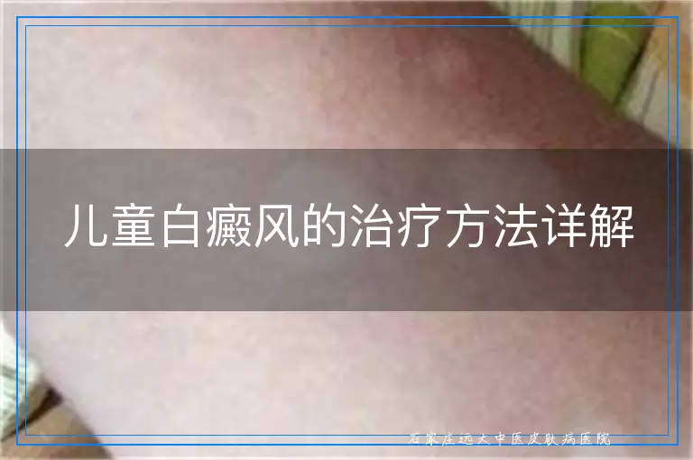 儿童白癜风的治疗方法详解