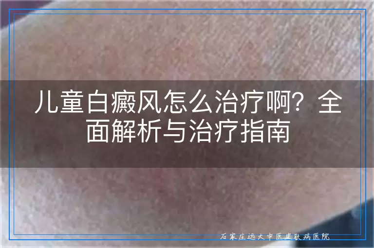 儿童白癜风怎么治疗啊？全面解析与治疗指南