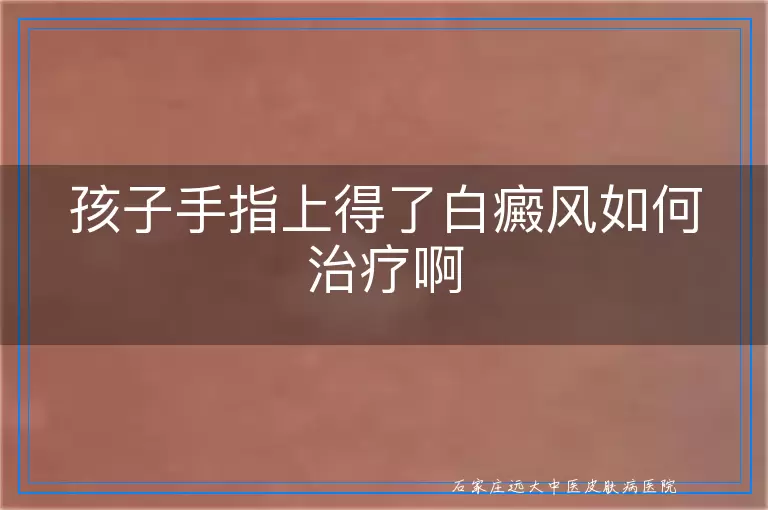 孩子手指上得了白癜风如何治疗啊