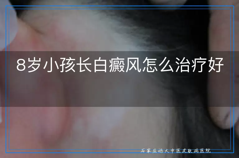 8岁小孩长白癜风怎么治疗好