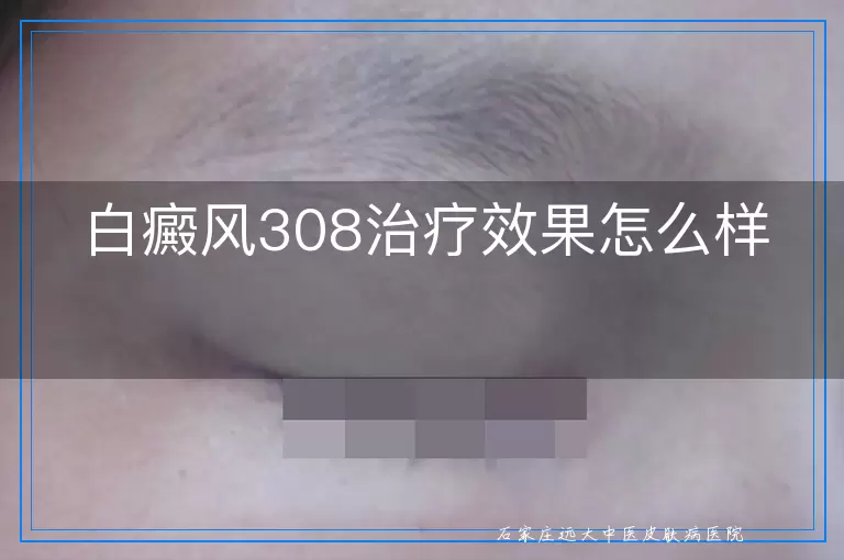 白癜风308治疗效果怎么样