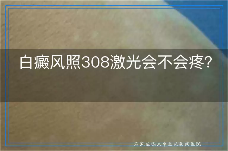 白癜风照308激光会不会疼？