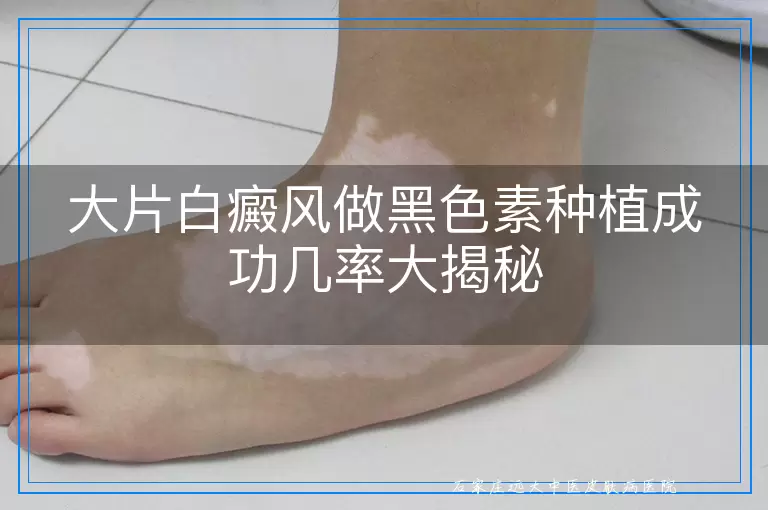 大片白癜风做黑色素种植成功几率大揭秘