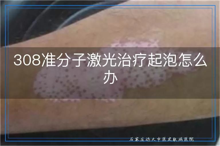 308准分子激光治疗起泡怎么办