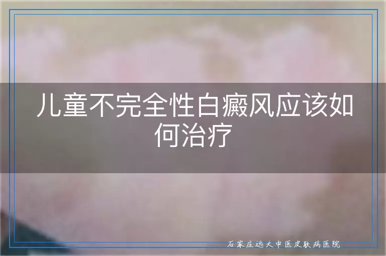 儿童不完全性白癜风应该如何治疗