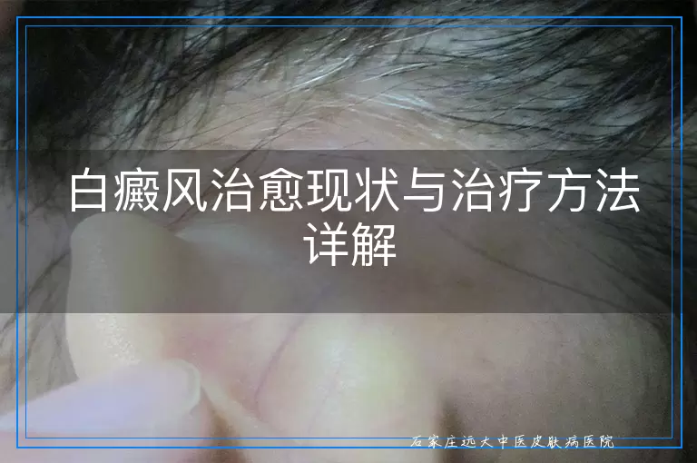 白癜风治愈现状与治疗方法详解