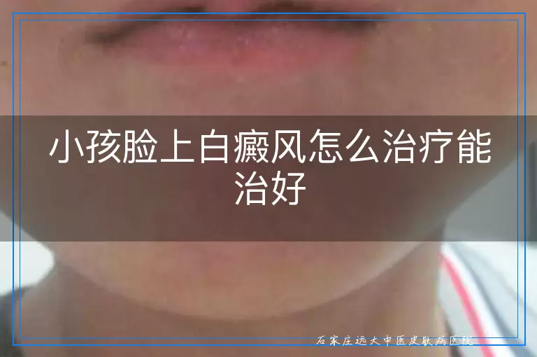 小孩脸上白癜风怎么治疗能治好