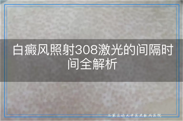白癜风照射308激光的间隔时间全解析