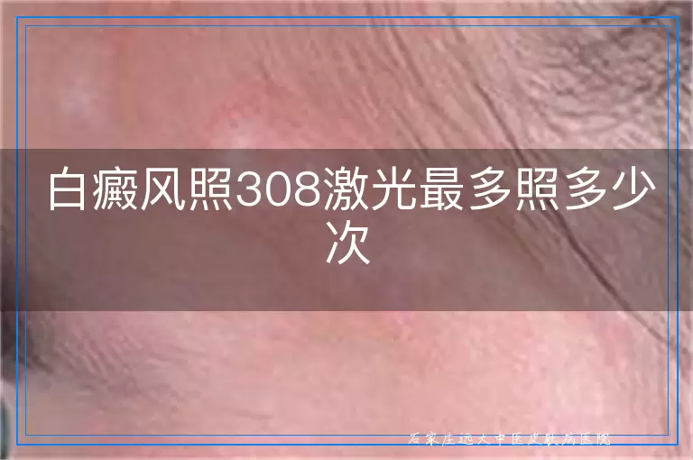 白癜风照308激光最多照多少次
