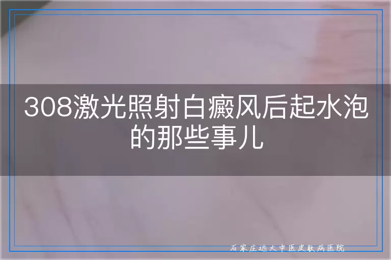 308激光照射白癜风后起水泡的那些事儿
